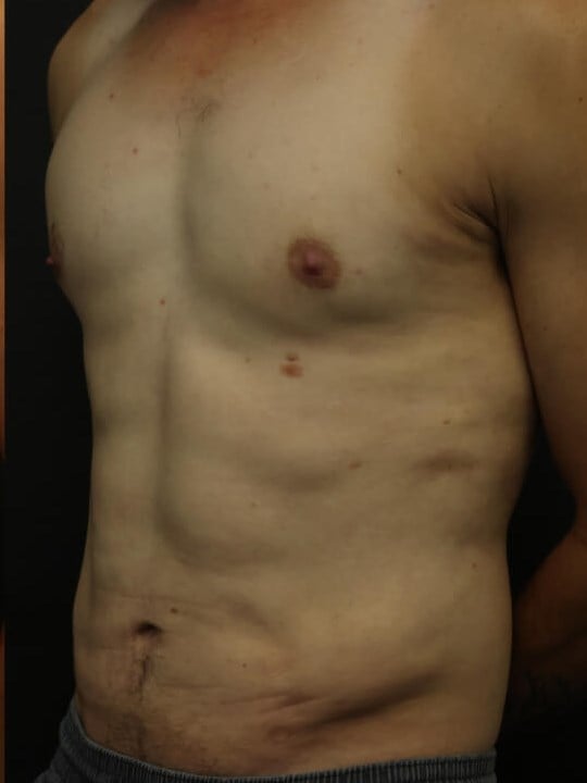 Awake Lipo of Chest & Abdomen After
