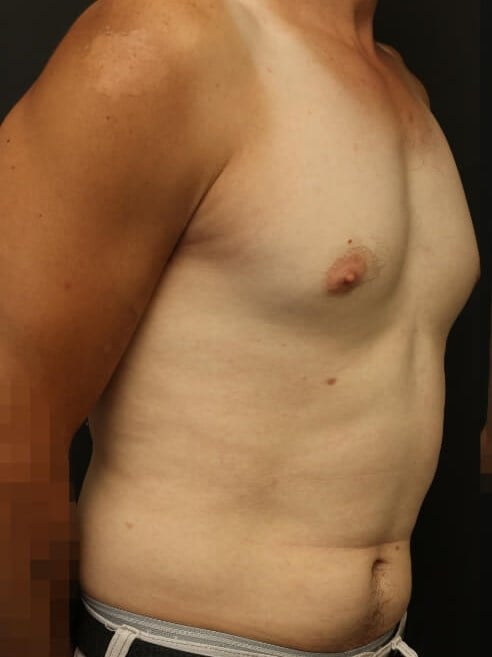 Awake Lipo of Chest & Abdomen Before