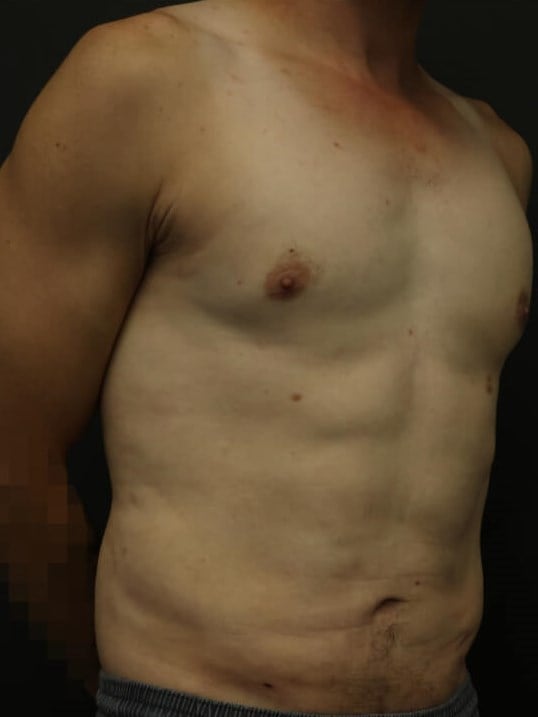 Awake Lipo of Chest & Abdomen After