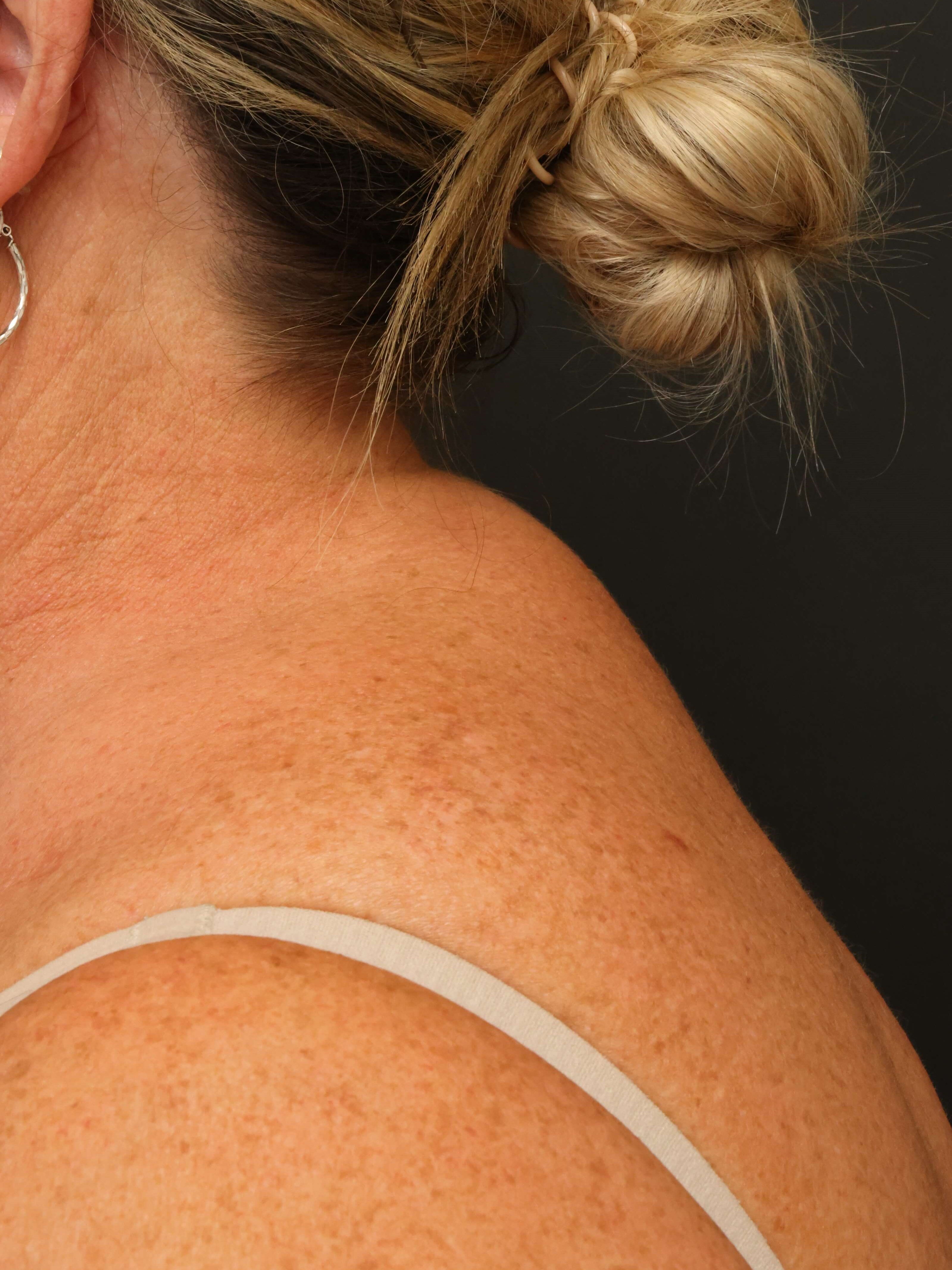 Awake Buffalo Hump Liposuction After