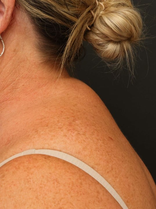 Awake Buffalo Hump Liposuction After