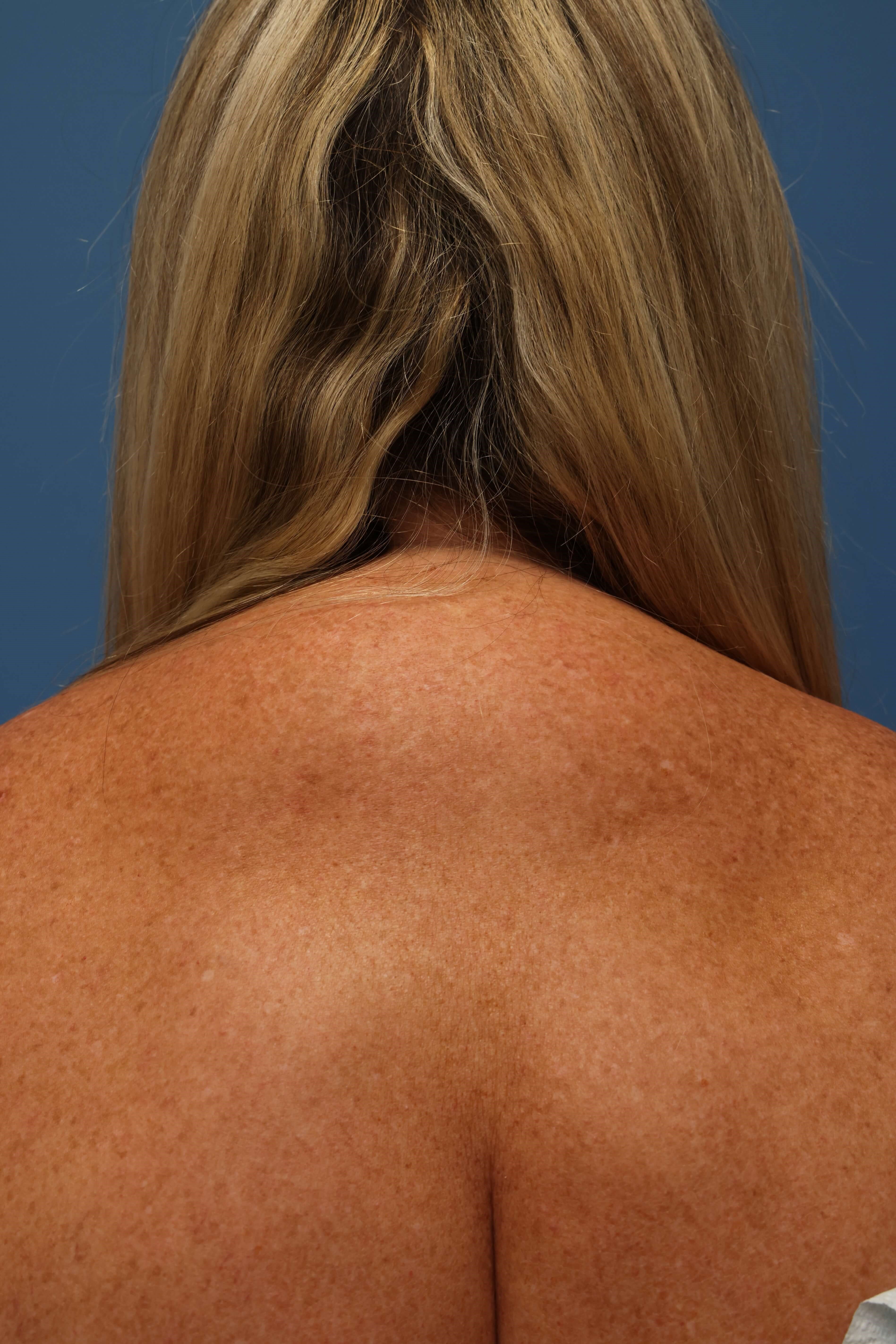 Awake Buffalo Hump Liposuction Before