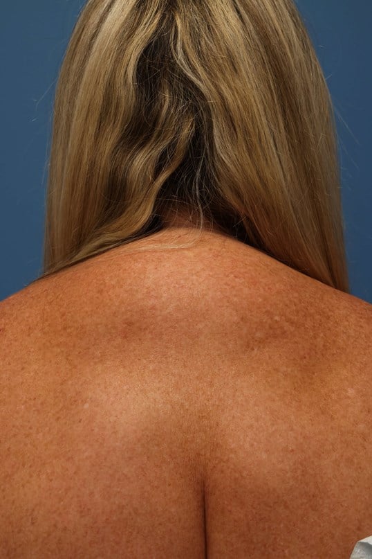 Awake Buffalo Hump Liposuction Before