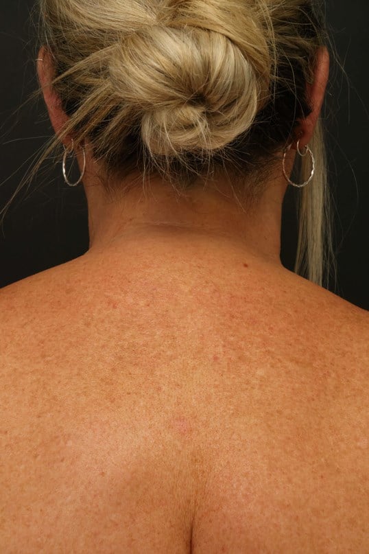 Awake Buffalo Hump Liposuction After