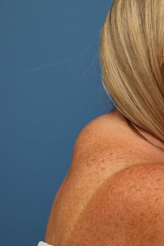 Awake Buffalo Hump Liposuction Before