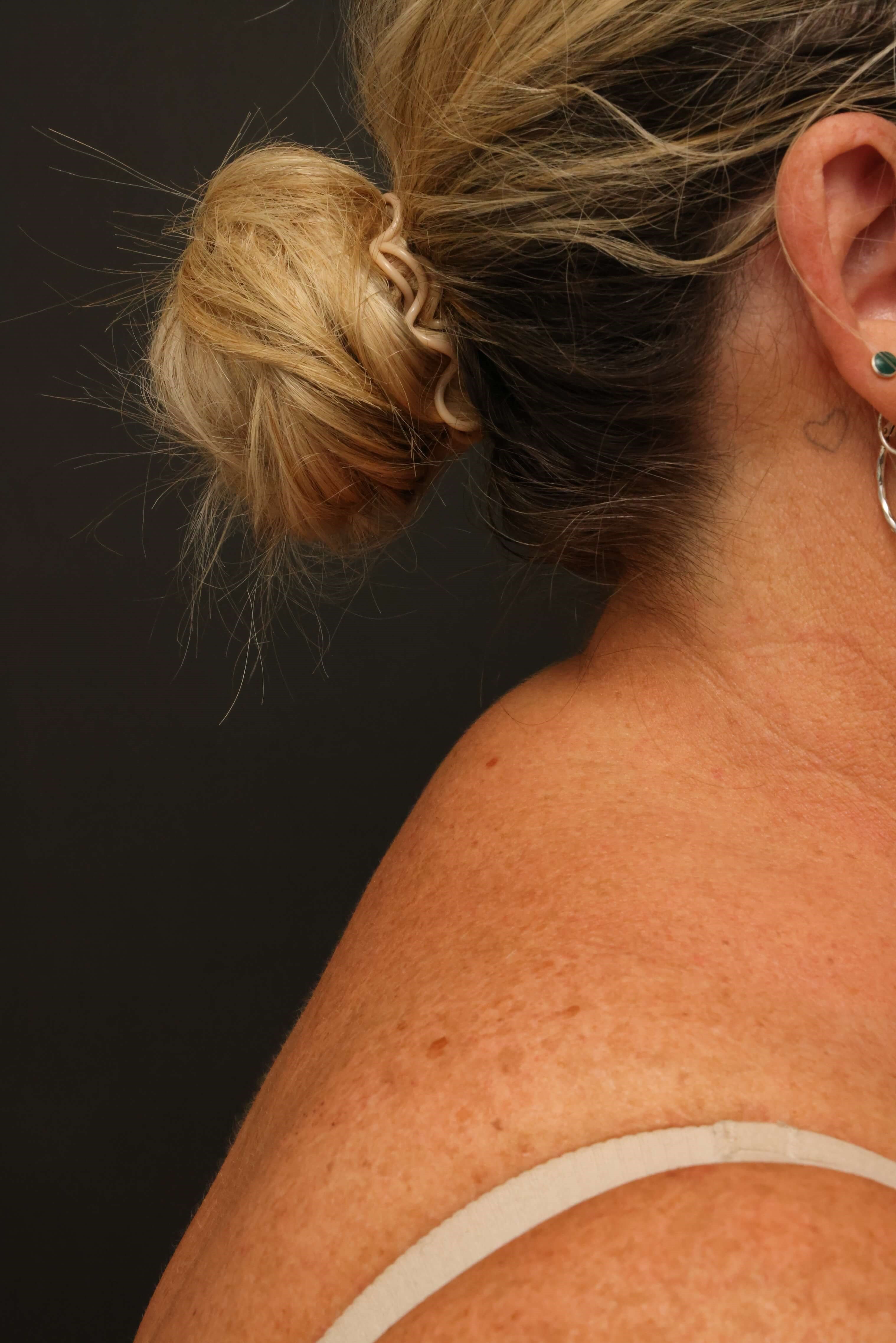 Awake Buffalo Hump Liposuction After