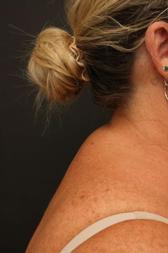 Awake Buffalo Hump Liposuction After