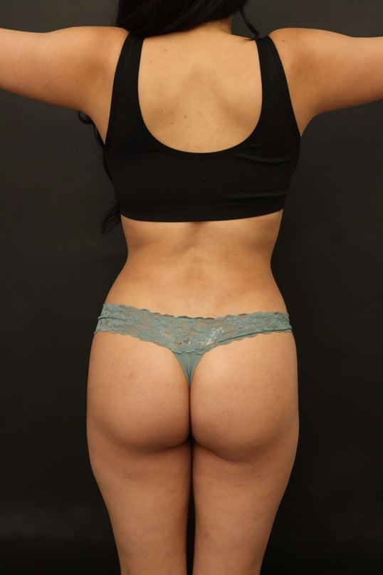 Awake Lipo of Lower Back After