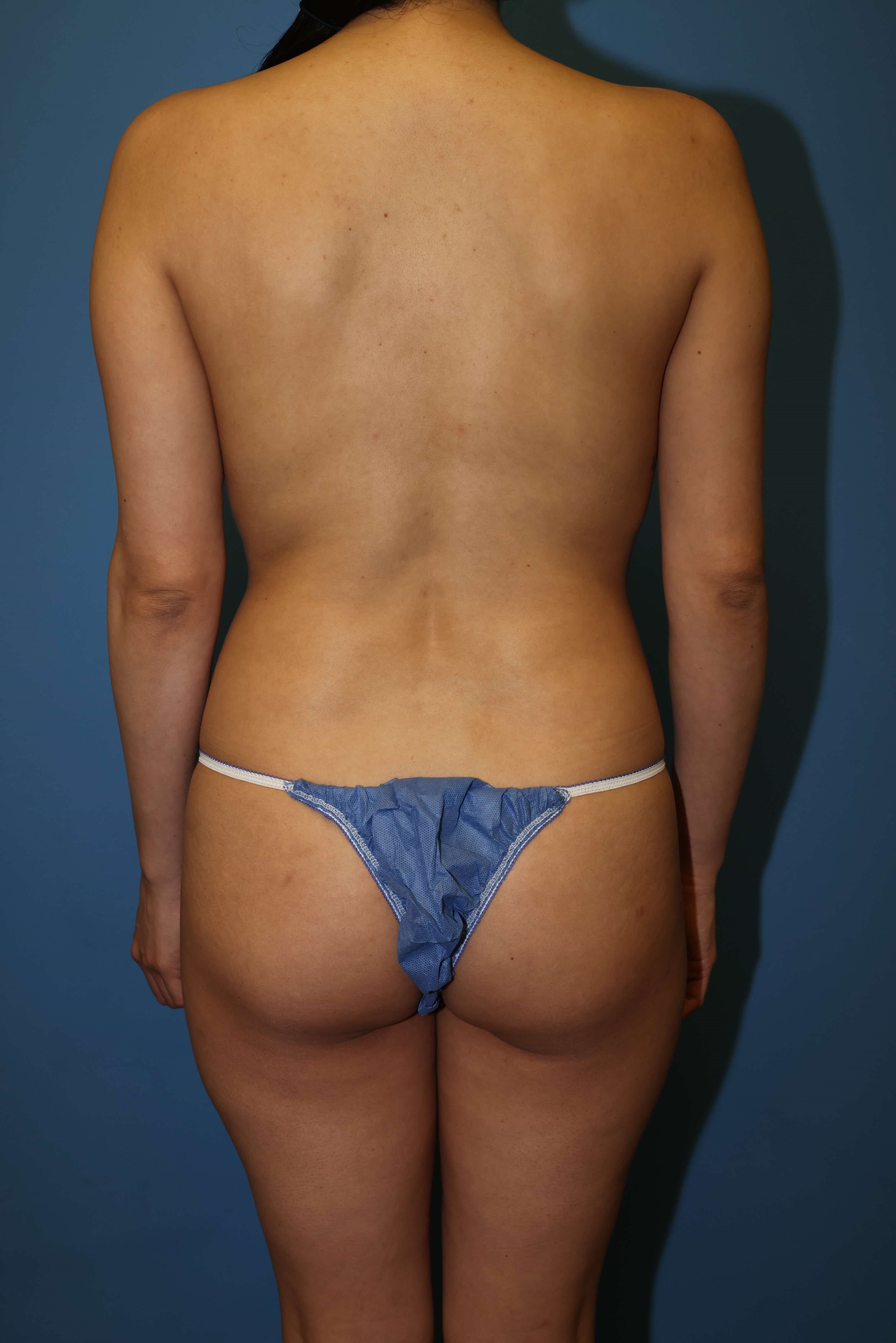 Awake Lipo of Lower Back Before