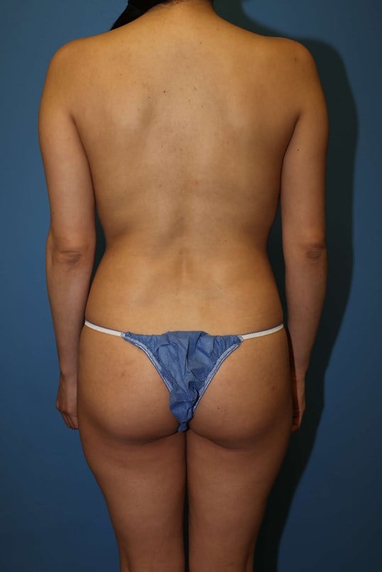 Awake Lipo of Lower Back Before