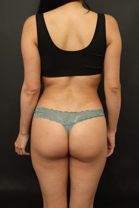 Awake Lipo of Lower Back After