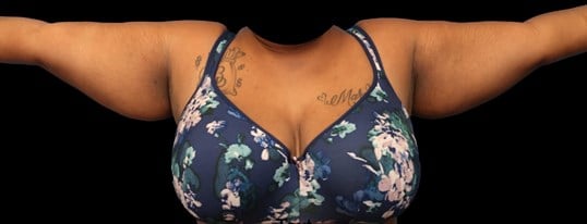 Awake Arm Liposuction Before