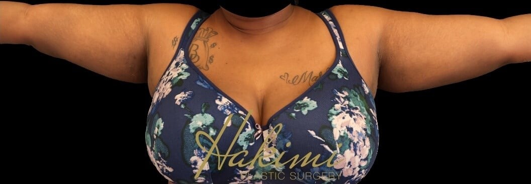 Awake Arm Liposuction After