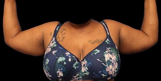 Awake Arm Liposuction Before