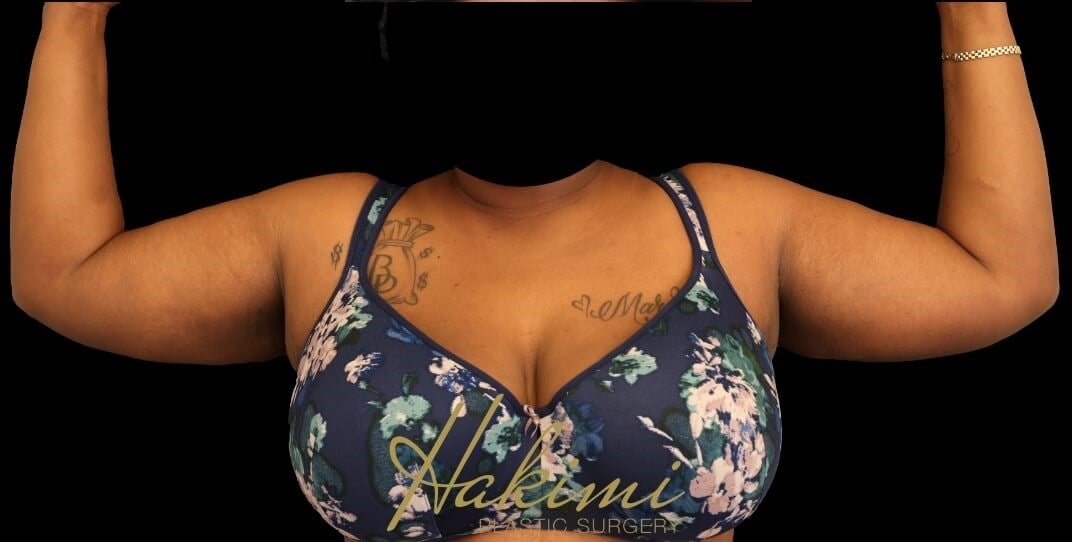 Awake Arm Liposuction After