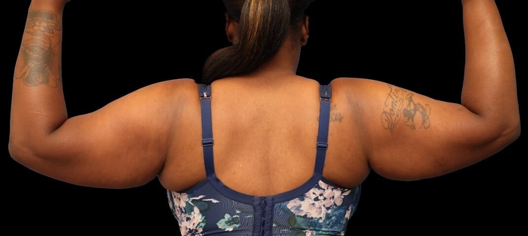 Awake Arm Liposuction Before