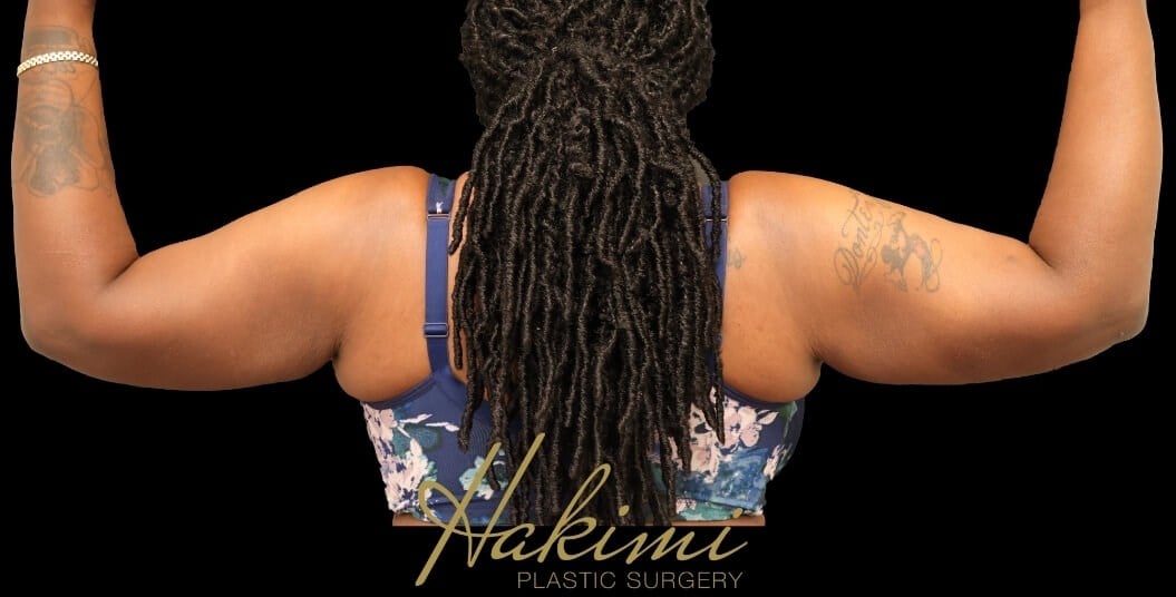 Awake Arm Liposuction After