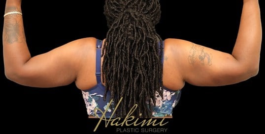 Awake Arm Liposuction After