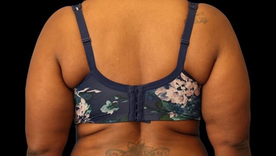 Awake Arm Liposuction Before