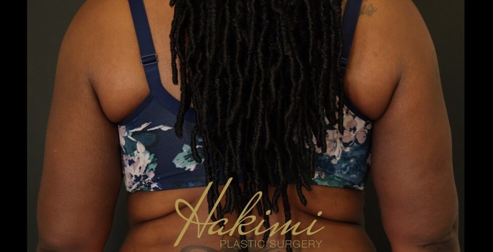 Awake Arm Liposuction After