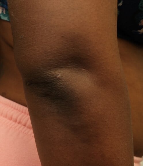 Awake Arm Liposuction Before