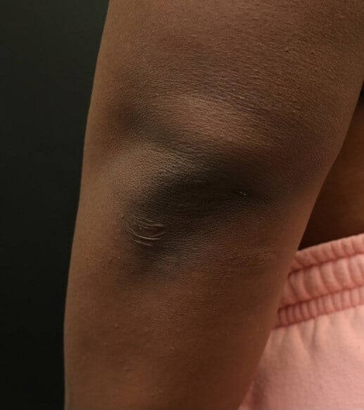 Awake Arm Liposuction After