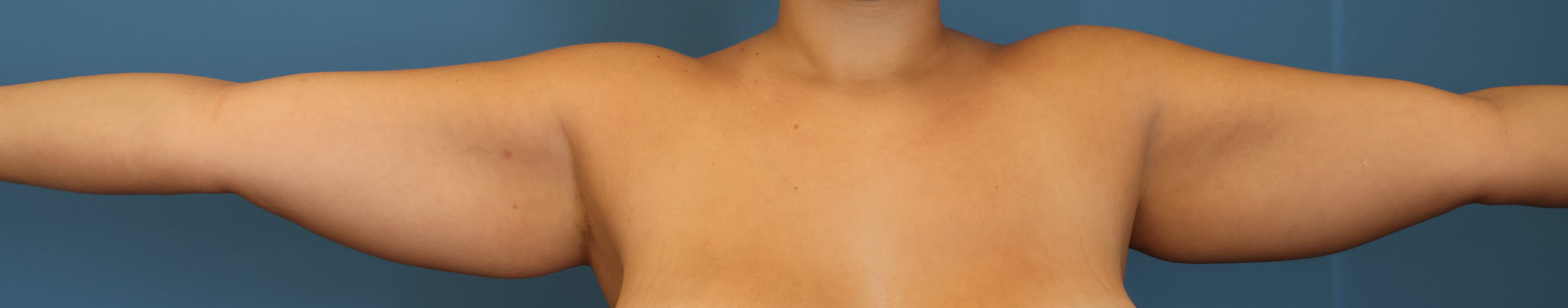 Awake Arm Liposuction Before