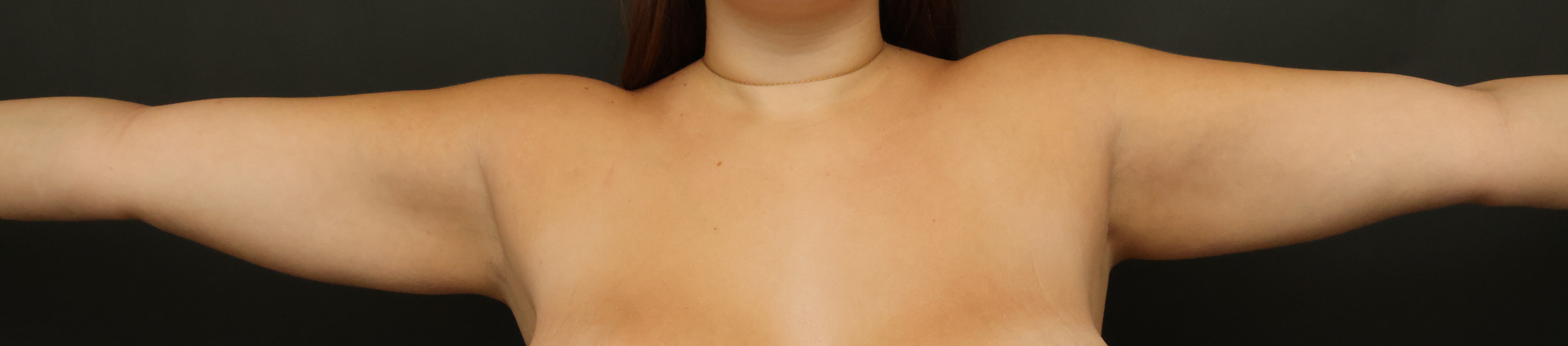 Awake Arm Liposuction After