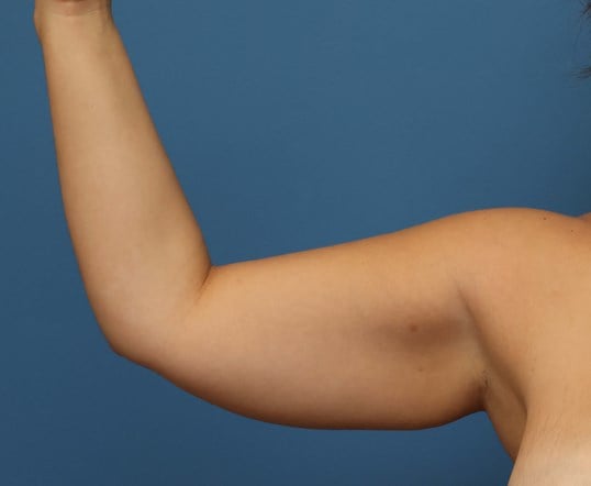 Awake Arm Liposuction Before