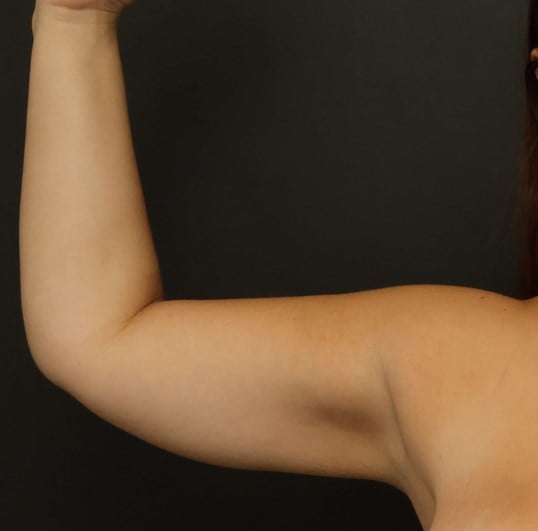 Awake Arm Liposuction After