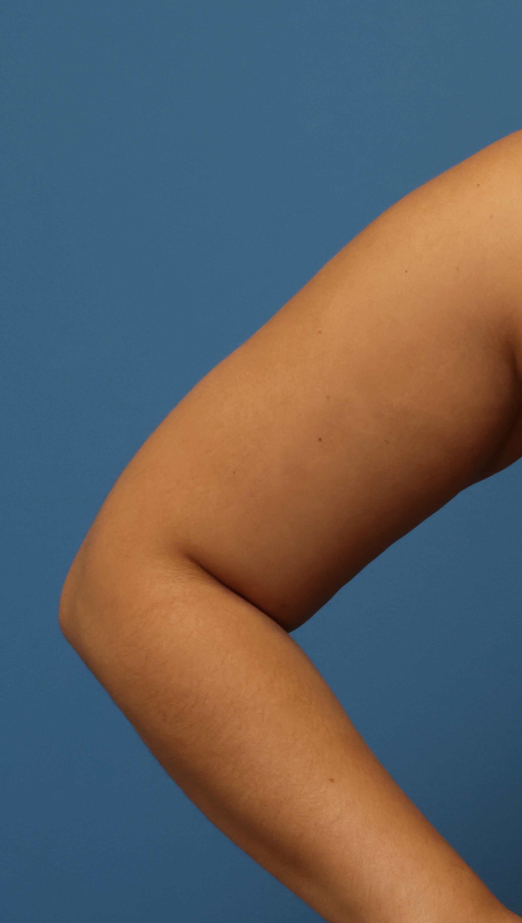 Awake Arm Liposuction Before