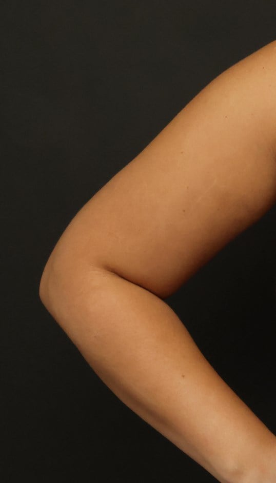 Awake Arm Liposuction After