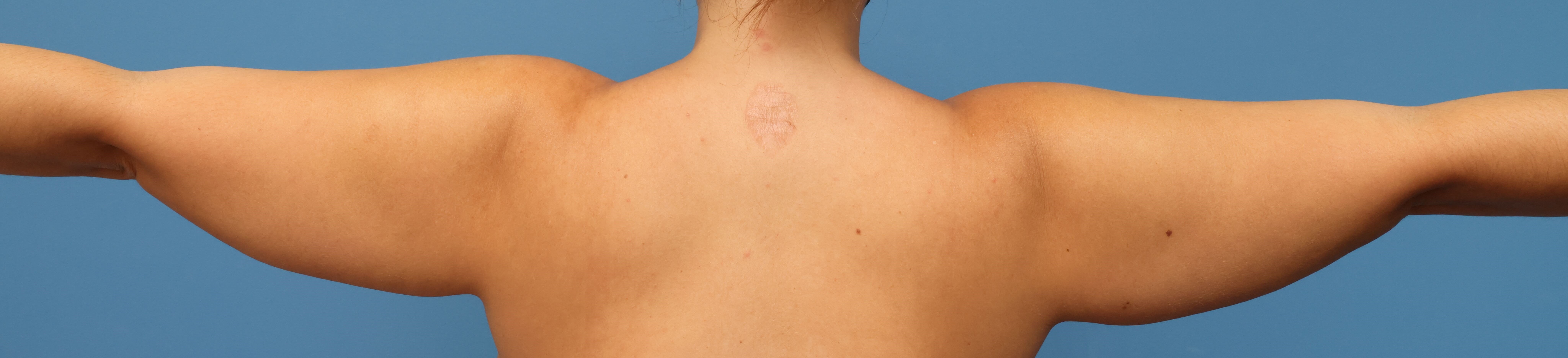 Awake Arm Liposuction Before