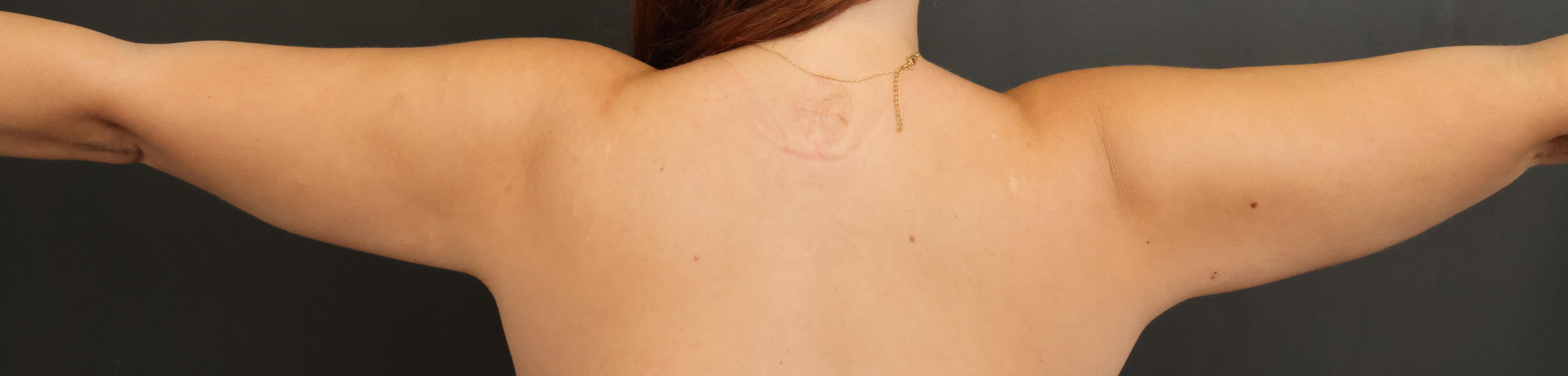 Awake Arm Liposuction After