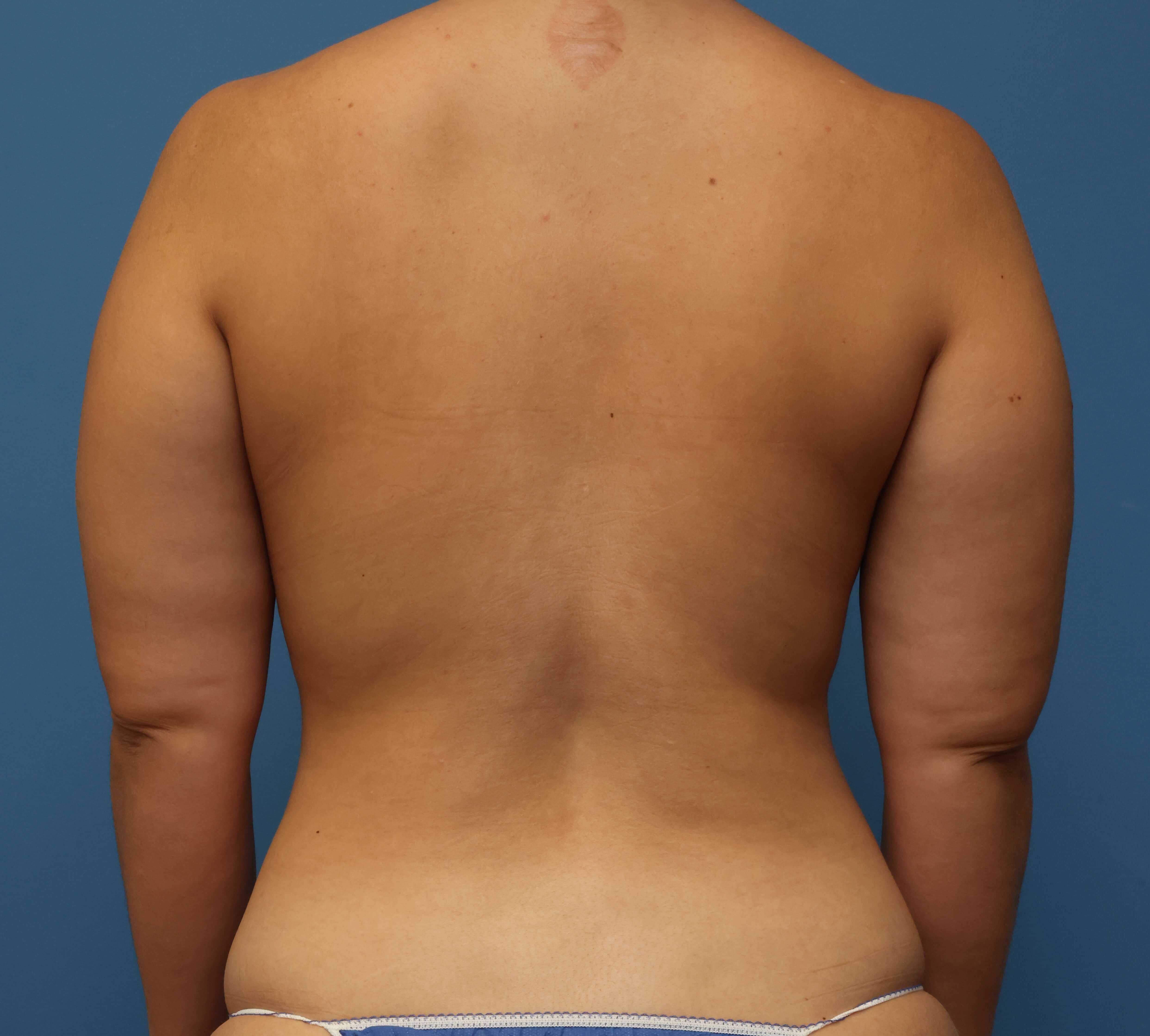 Awake Arm Liposuction Before