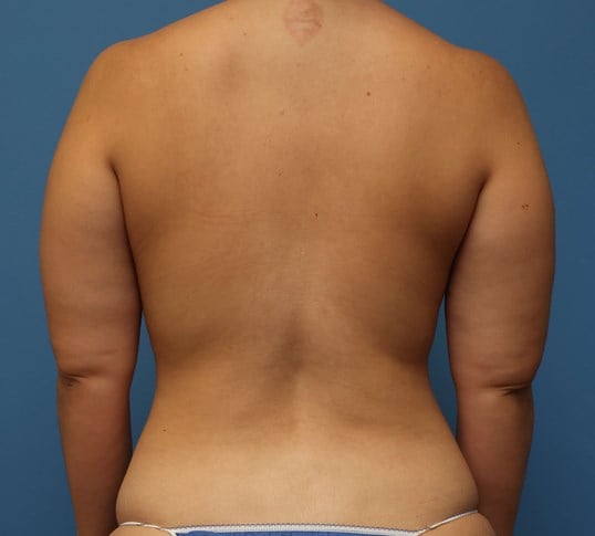 Awake Arm Liposuction Before