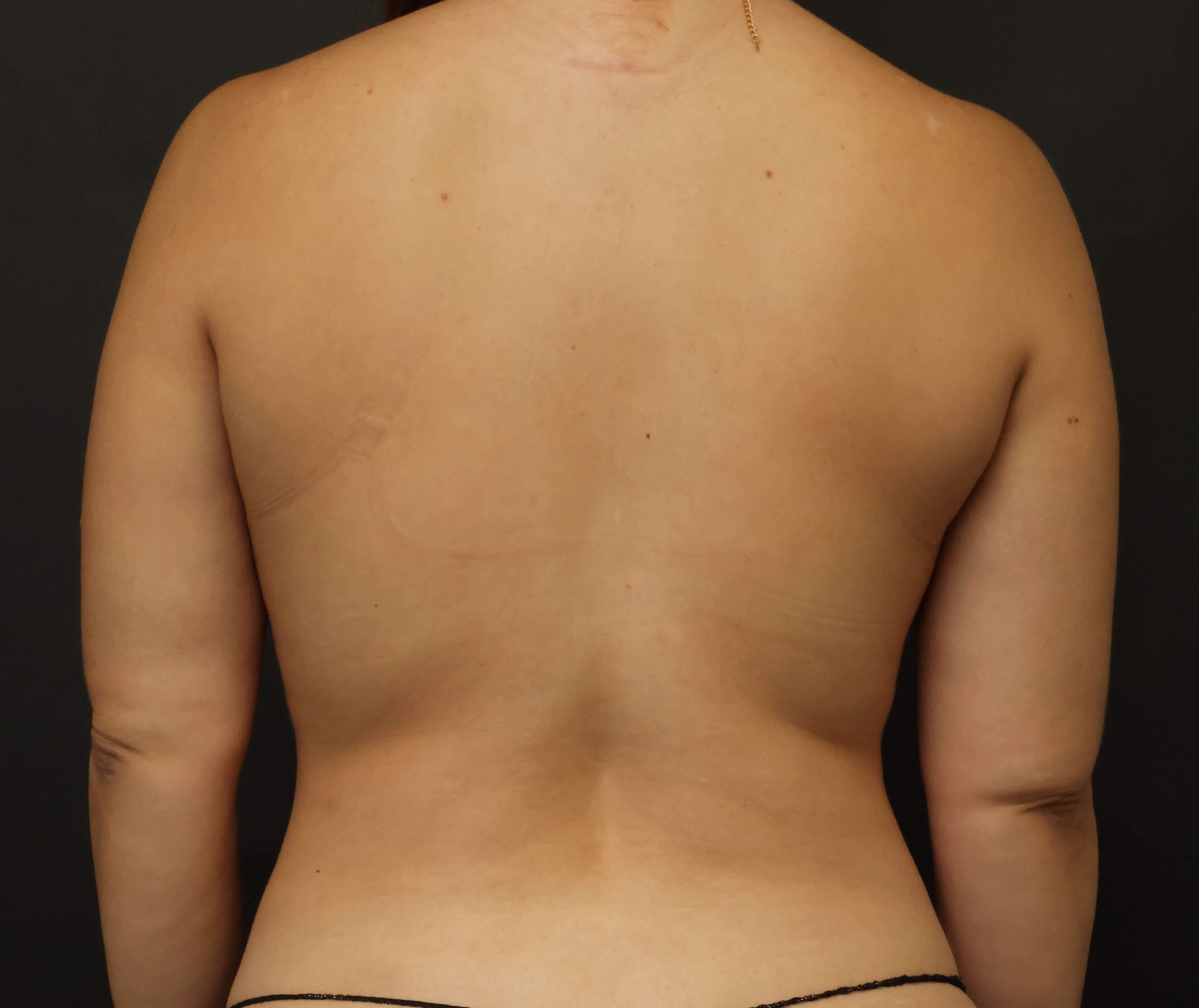 Awake Arm Liposuction After