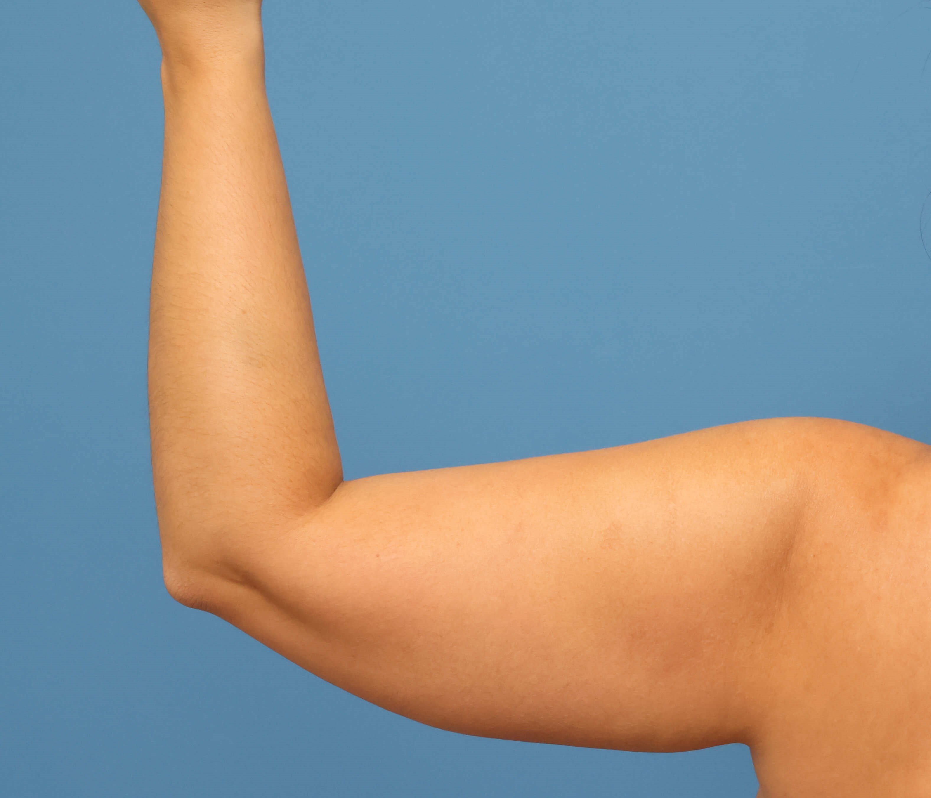 Awake Arm Liposuction Before
