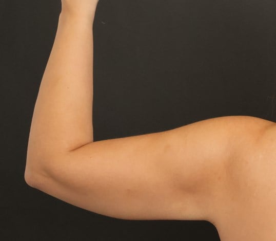 Awake Arm Liposuction After
