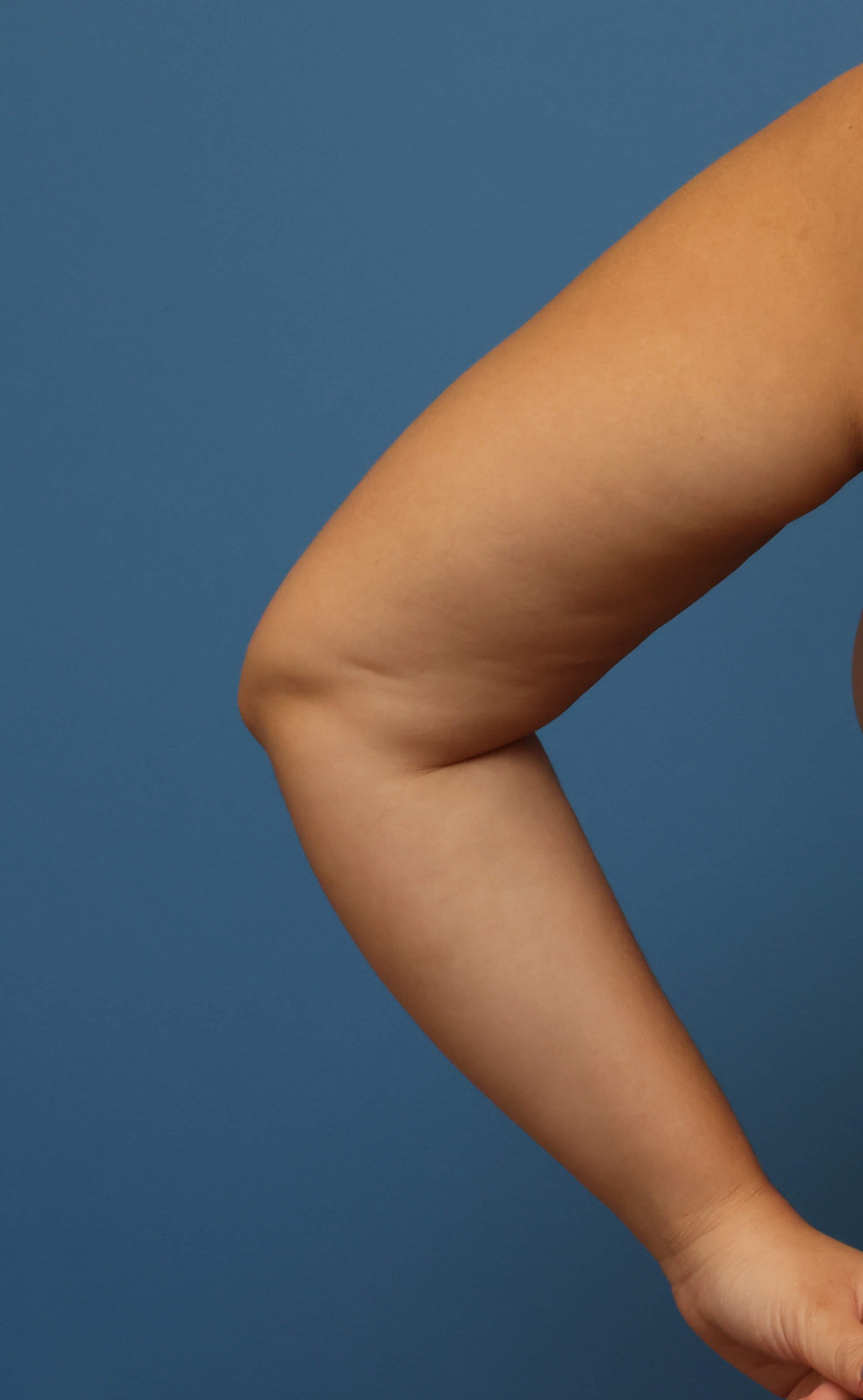 Awake Arm Liposuction Before