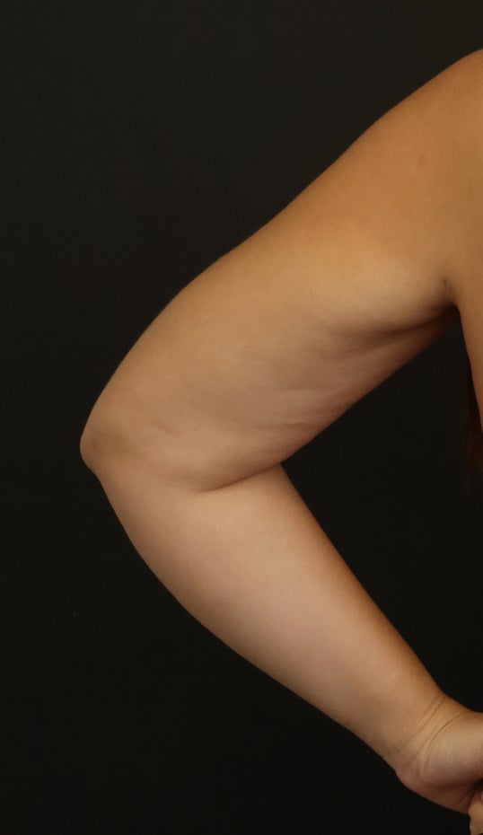 Awake Arm Liposuction After