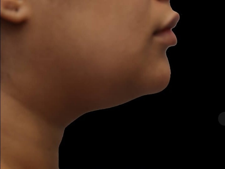 Awake Neck Liposuction Before