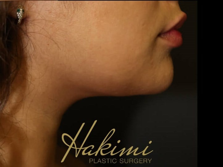 Awake Neck Liposuction After