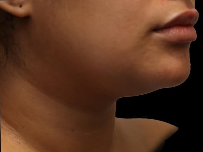 Awake Neck Liposuction Before