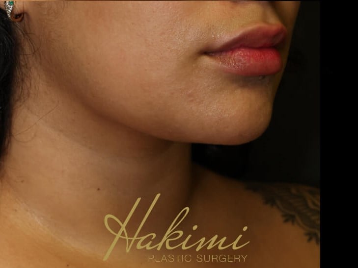 Awake Neck Liposuction After