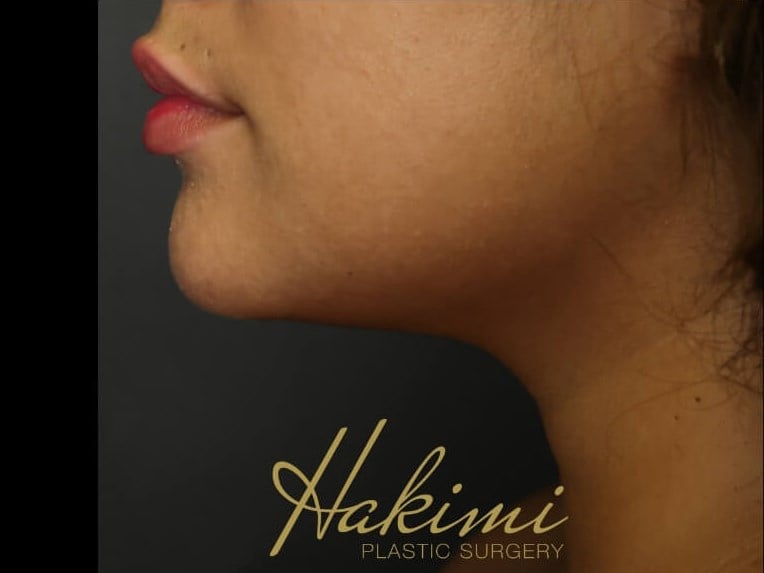 Awake Neck Liposuction After