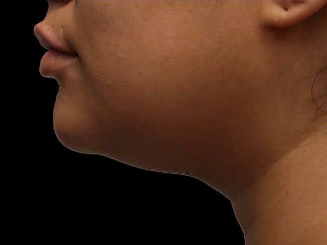 Awake Neck Liposuction Before