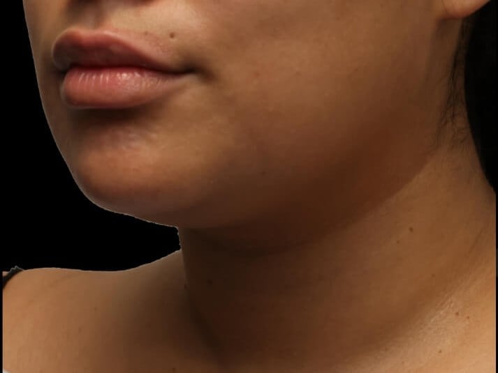 Awake Neck Liposuction Before