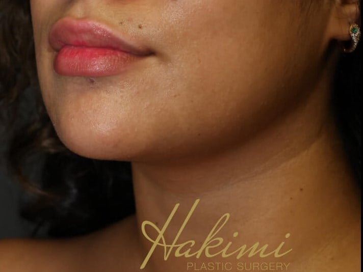 Awake Neck Liposuction After