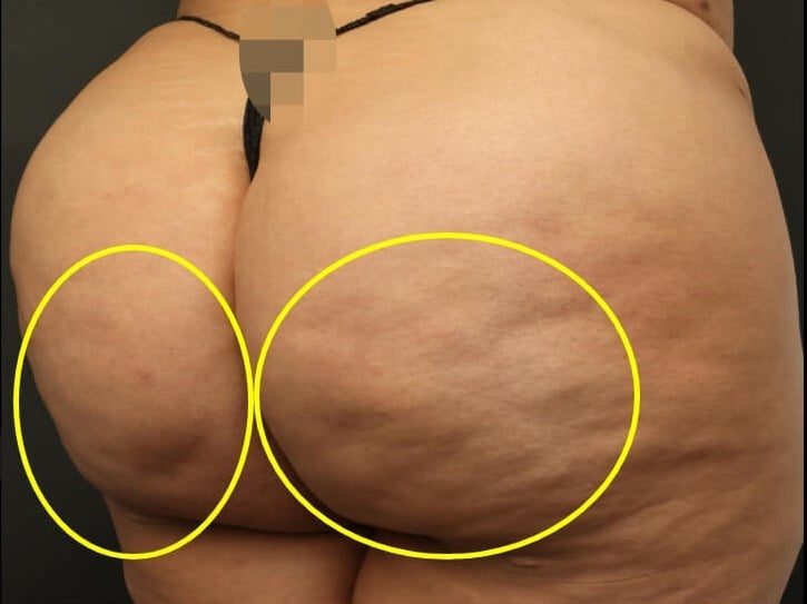 Avéli Cellulite Procedure Before